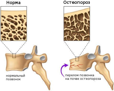 Кто столкнется с остеопорозом, причины и лечение.